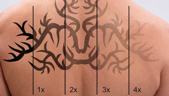 borrar tatuajes