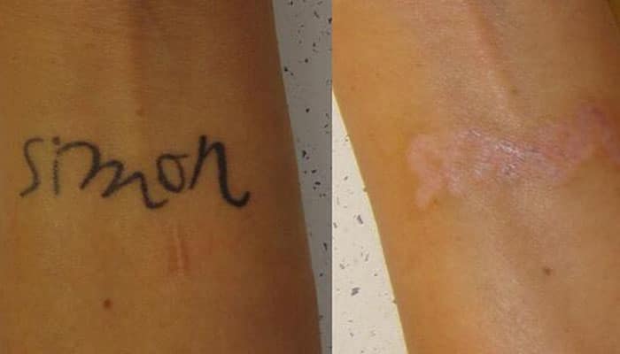 Borrar tatuajes