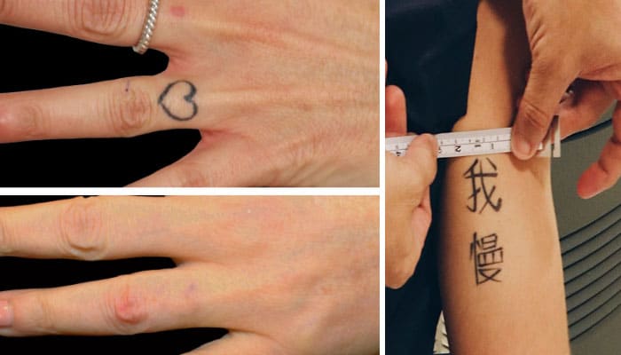 cómo borrar tatuajes