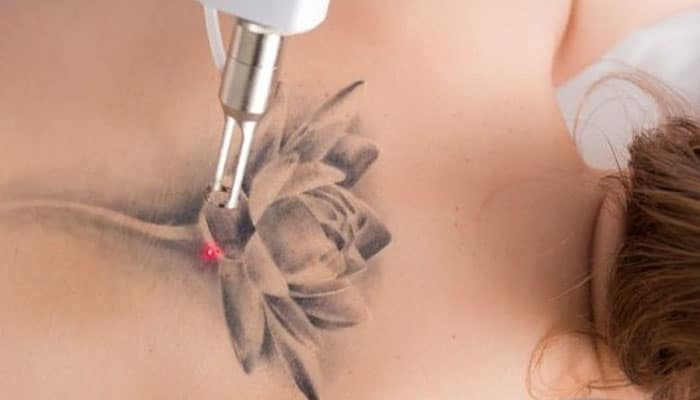 es posible borrar tatuajes