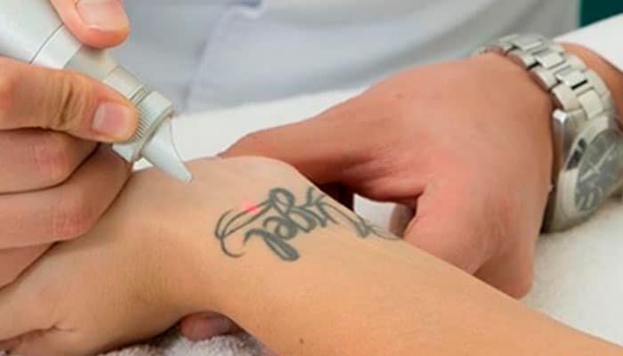 borrar tatuajes