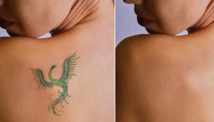 se pueden borrar tatuajes