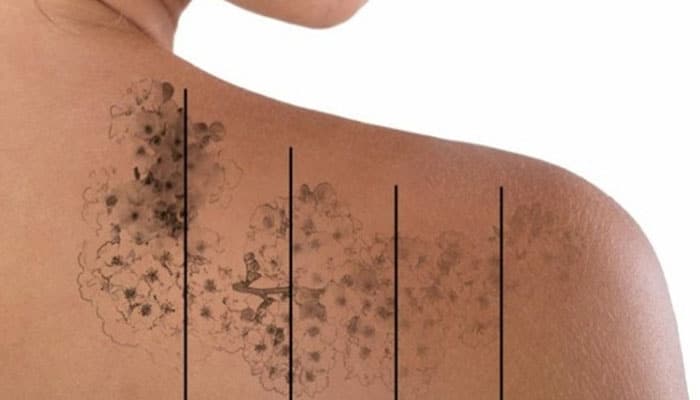 técnicas para borrar tatuajes