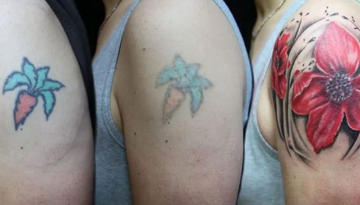 borrar tatuajes feos