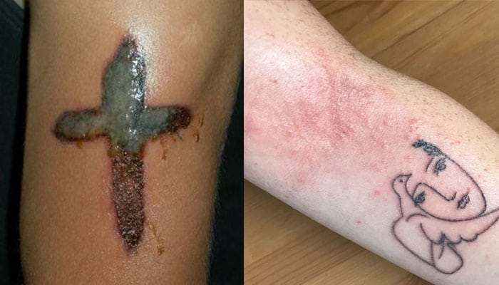 tatuaje infectado