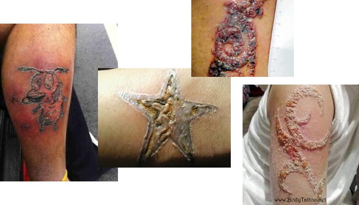 tatuajes infectados
