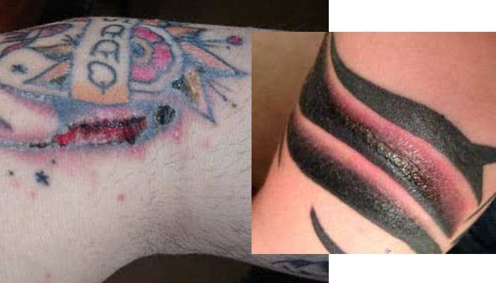 tatar tatuajes infectados