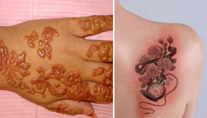 tatuajes infectados en manos