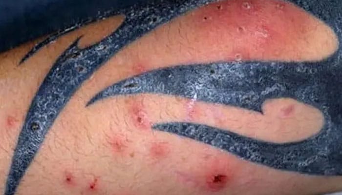 tatuajes infectados