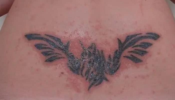 tratar tatuajes infectados
